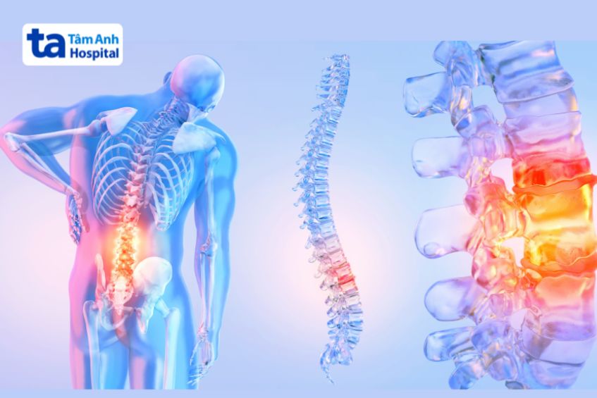 Tư thế ngồi sự ảnh hưởng người đau thần kinh tọa