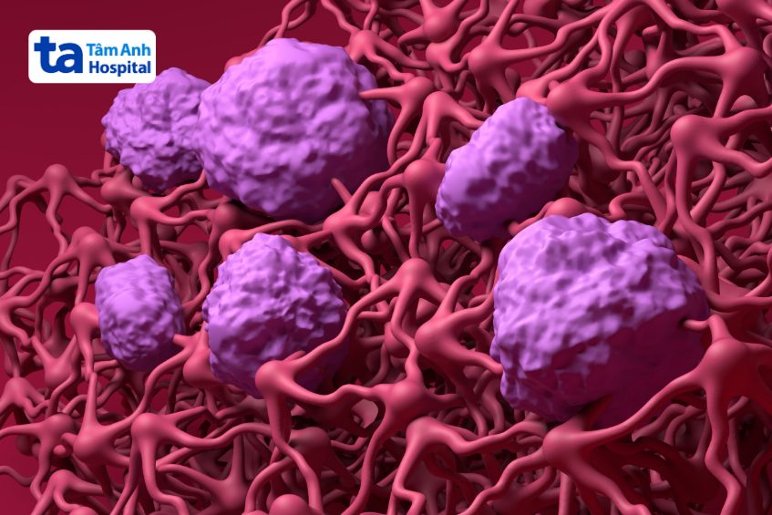 tuổi thọ bệnh u não lành tính phụ thuộc nhiều yếu tố