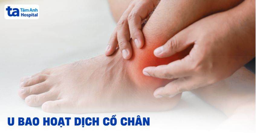 U bao hoạt dịch cổ chân: Nguyên nhân, dấu hiệu, cách điều trị