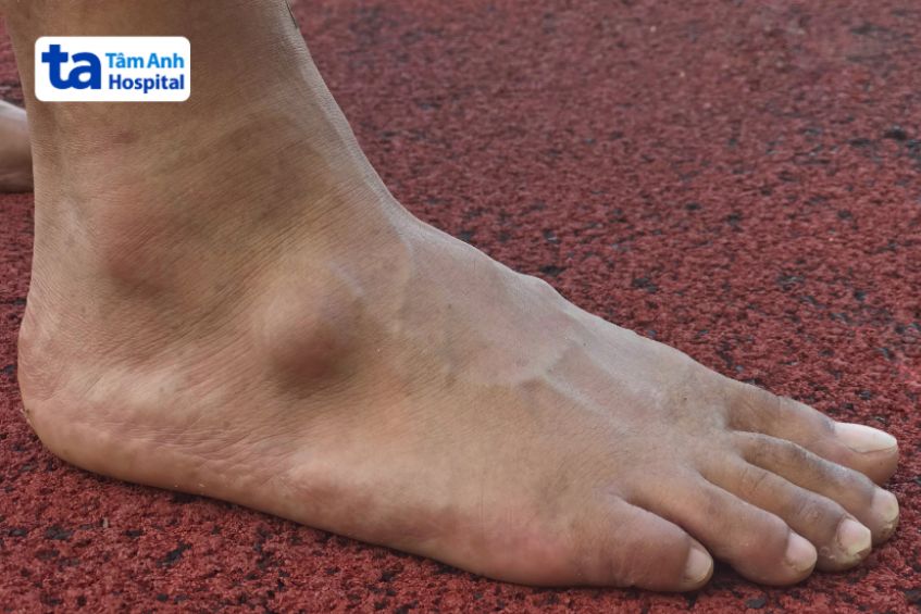 U bao hoạt dịch gây ra khối u sưng