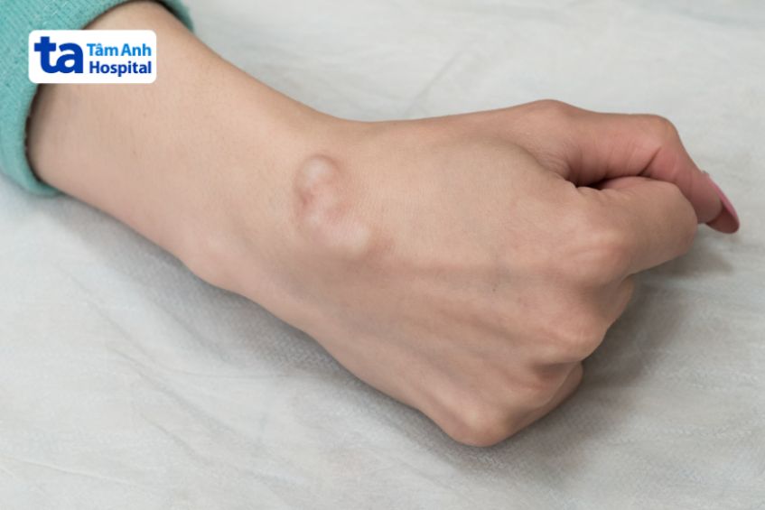 U bao hoạt dịch là gì