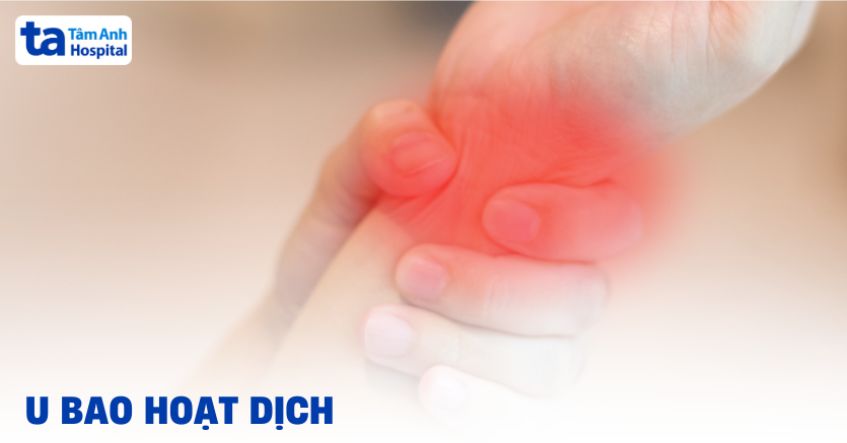 U bao hoạt dịch: Nguyên nhân, dấu hiệu, phòng ngừa và điều trị