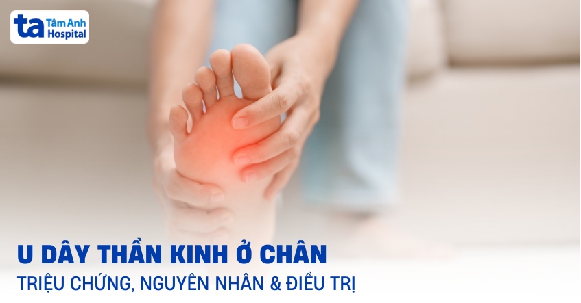 U dây thần kinh ở chân: Triệu chứng, nguyên nhân và điều trị