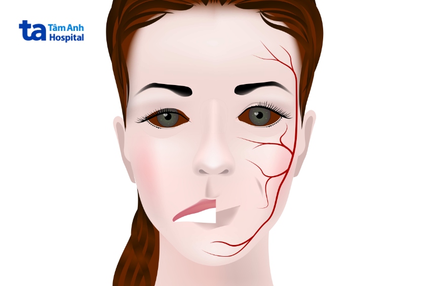 u dây thần kinh số 7 thường lành tính