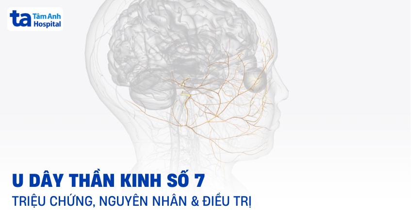 U dây thần kinh số 7: Triệu chứng, nguyên nhân, chẩn đoán, điều trị