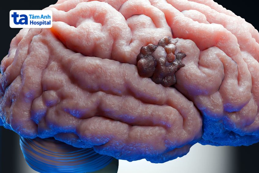 u màng não là một dạng u não lành tính