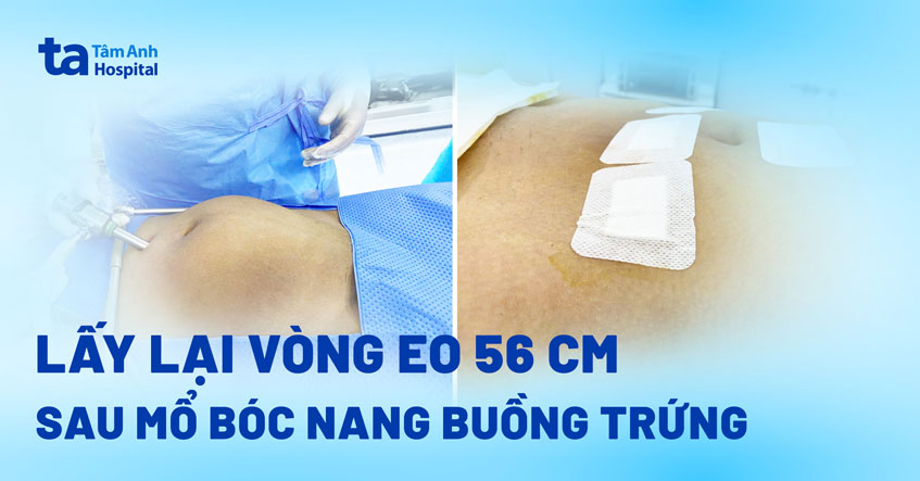 U buồng trứng khiến bụng to như mang thai 4 tháng