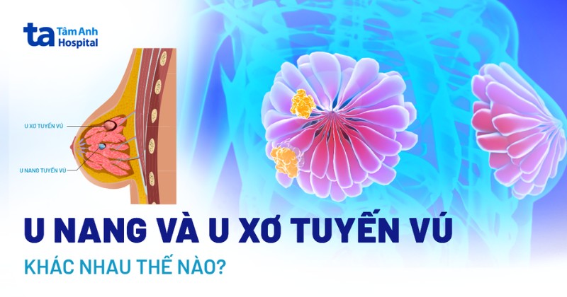 U nang và u xơ tuyến vú khác nhau như thế nào? Có nguy hiểm không?