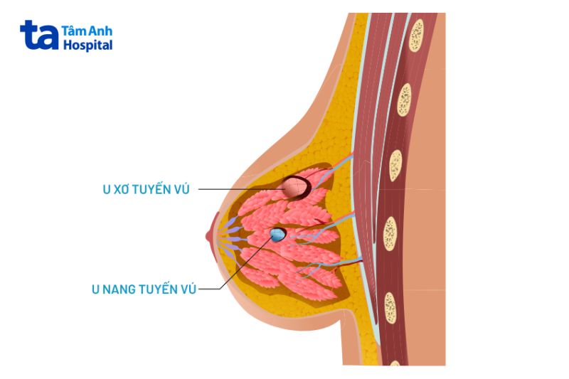 u nang và u xơ tuyến vú