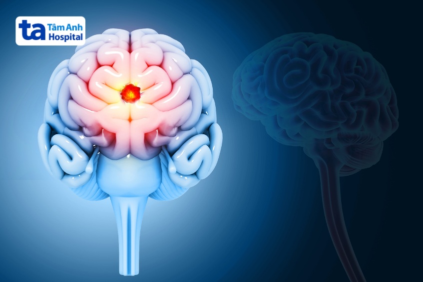 u não lành tình 3 cm cần loại bỏ