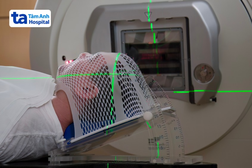 u não lành tính cần xạ trị