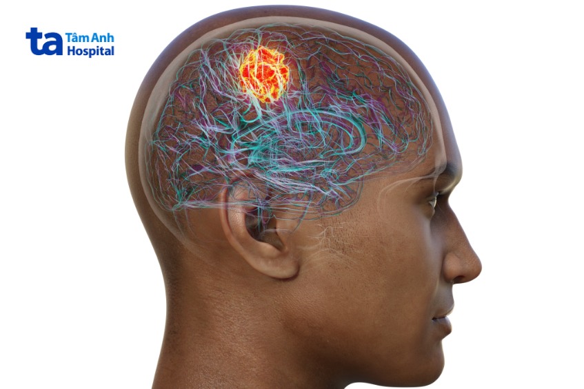 u não lành tính có thể sống sót nếu điều trị