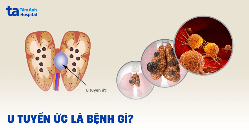 u tuyến ức