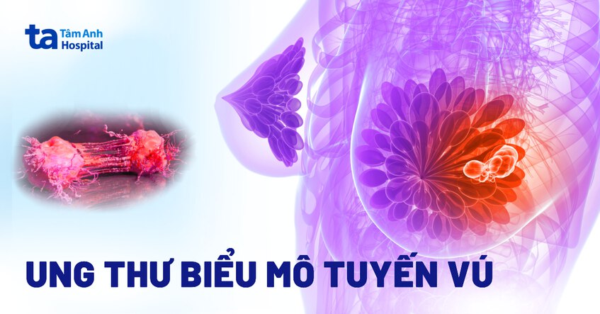 Ung thư biểu mô tuyến vú: Nguyên nhân, triệu chứng, điều trị
