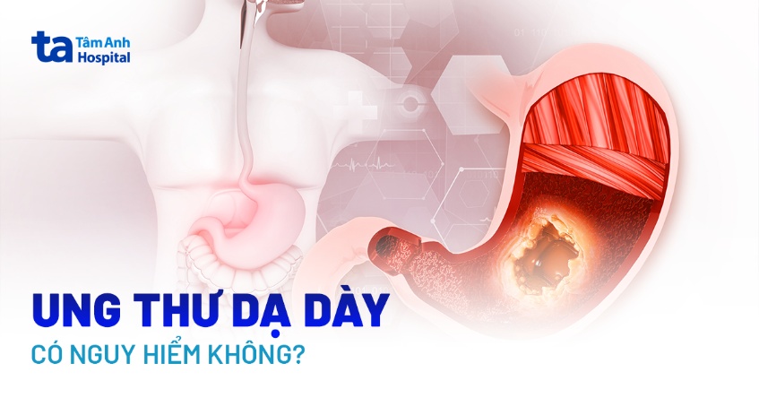 Ung thư dạ dày có nguy hiểm không? Ảnh hưởng sức khỏe ra sao?