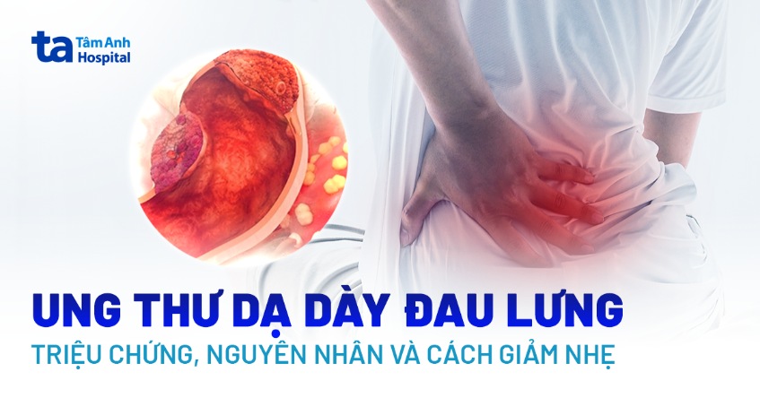Ung thư dạ dày đau lưng: Triệu chứng, nguyên nhân và cách giảm nhẹ