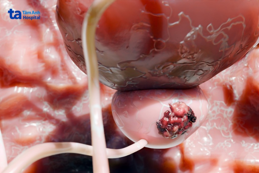 ung thư tiền liệt tuyến không lây nhiễm