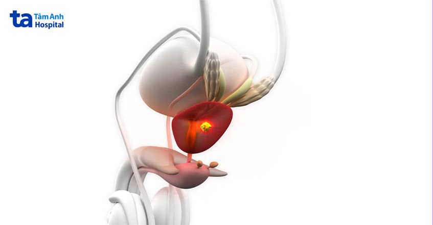ung thư tuyến tiền liệt có thể gây bí tiểu