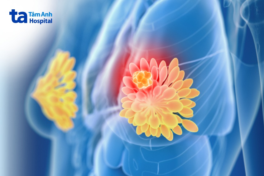 ung thư vú thường xuất hiện ở độ tuổi nào