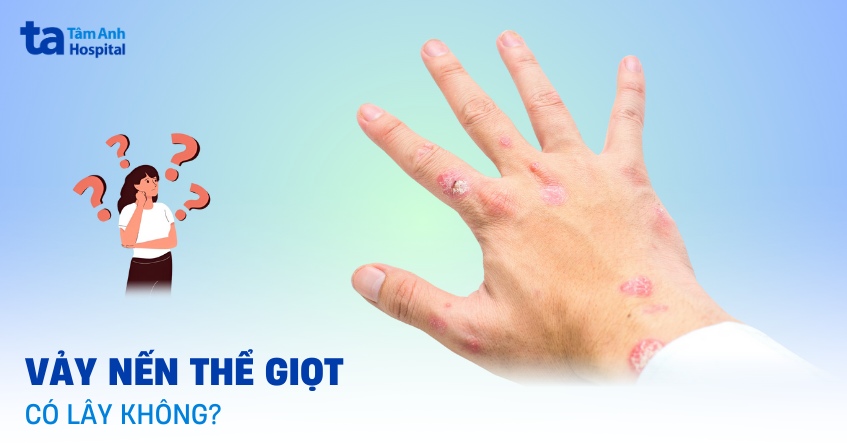 vảy nến thể giọt có lây không