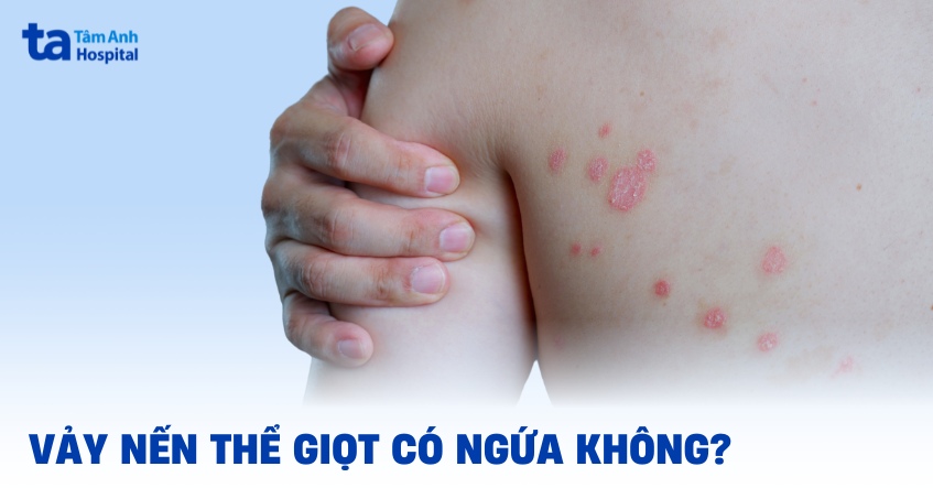 Vảy nến thể giọt có ngứa không? 6 cách giảm ngứa hiệu quả tại nhà