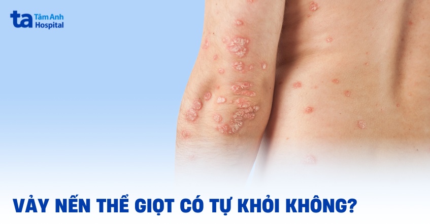 Vảy nến thể giọt có tự hết không? Có khỏi khi không điều trị?