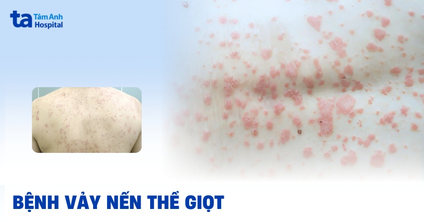 vảy nến thể giọt