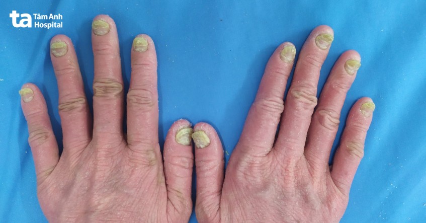 vì sao bệnh nhân vảy nến cần được chăm sóc kĩ càng