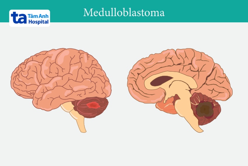 vị trí kích thước u nguyên bảo tủy ảnh hưởng điều trị