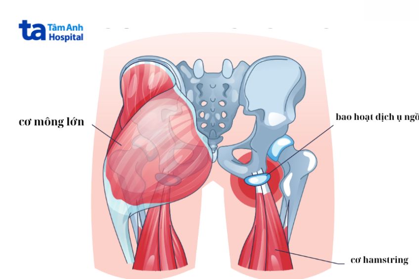 Viêm bao hoạt dịch ụ ngồi là gì