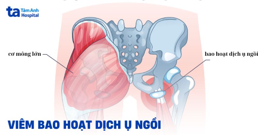 Viêm bao hoạt dịch ụ ngồi: Nguyên nhân, dấu hiệu và điều trị