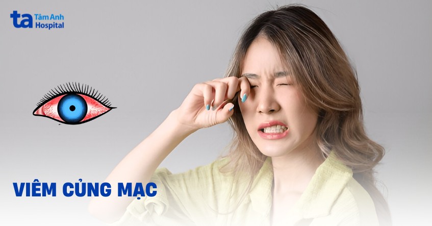 Viêm củng mạc: Nguyên nhân, triệu chứng và cách điều trị