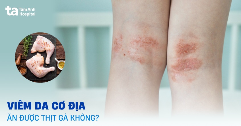 Viêm da cơ địa có ăn được thịt gà không?