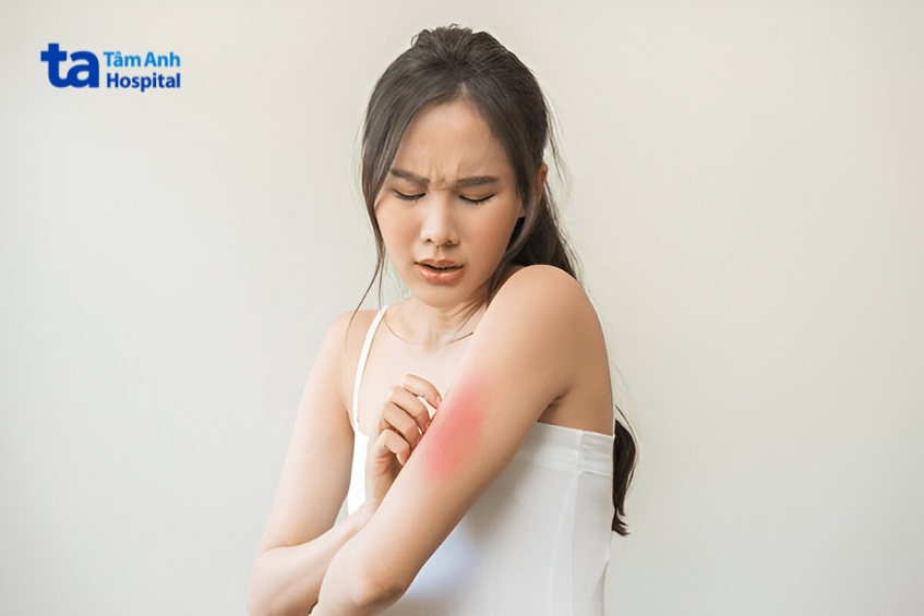 viêm da cơ địa kiêng gì trong sinh hoạt hằng ngày