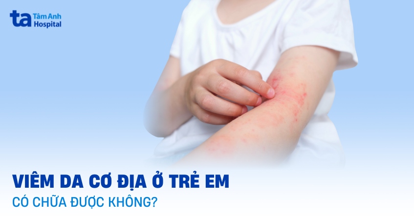 viêm da cơ địa ở trẻ em có chữa được không