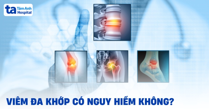 Bệnh viêm đa khớp có nguy hiểm không? 5 biến chứng thường gặp