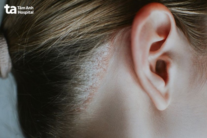 vêm da tiết bã có vảy màu trắng