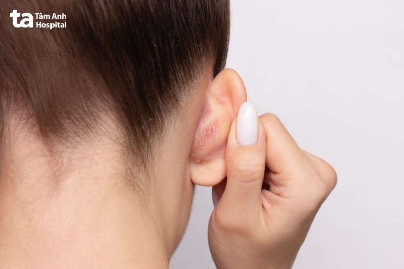 Hình ảnh viêm da tiết bã ở tai