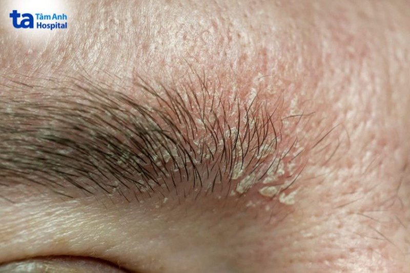 Hình ảnh viêm da tiết bã ở gian mày