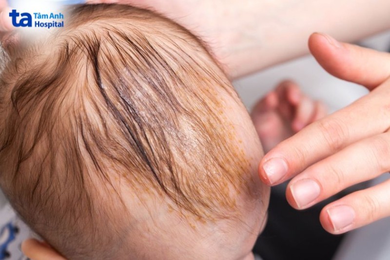 vêm da tiết bã thường xuất hiện ở trẻ sơ sinh