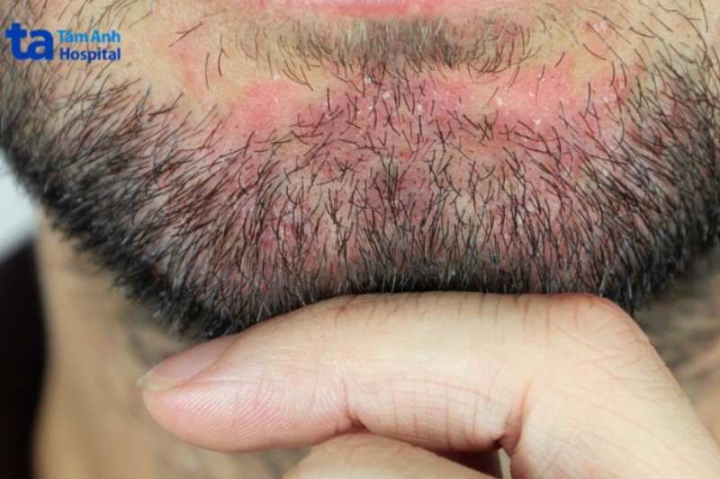 viêm da tiết bã xuất hiện ở cằm