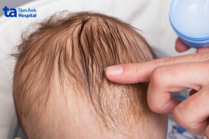 Viêm da tiết bã da đầu ở trẻ sơ sinh
