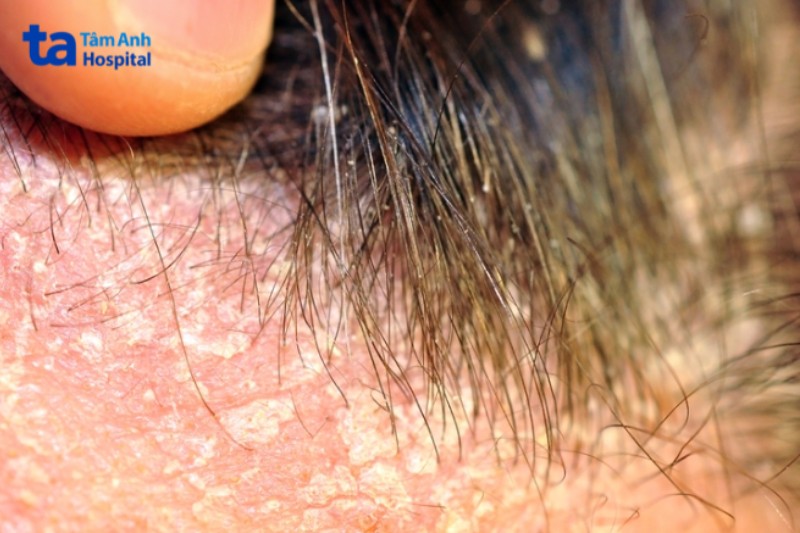 Cận cảnh viêm da tiết bã da đầu