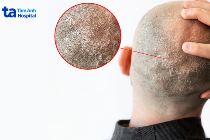 Viêm da tiết bã bùng phát trên da đầu