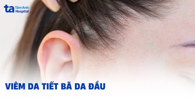 Viêm da tiết bã da đầu: Hình ảnh, nguyên nhân và cách điều trị