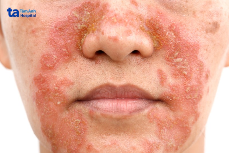 viêm da tiết bã lan rộng trên mặt