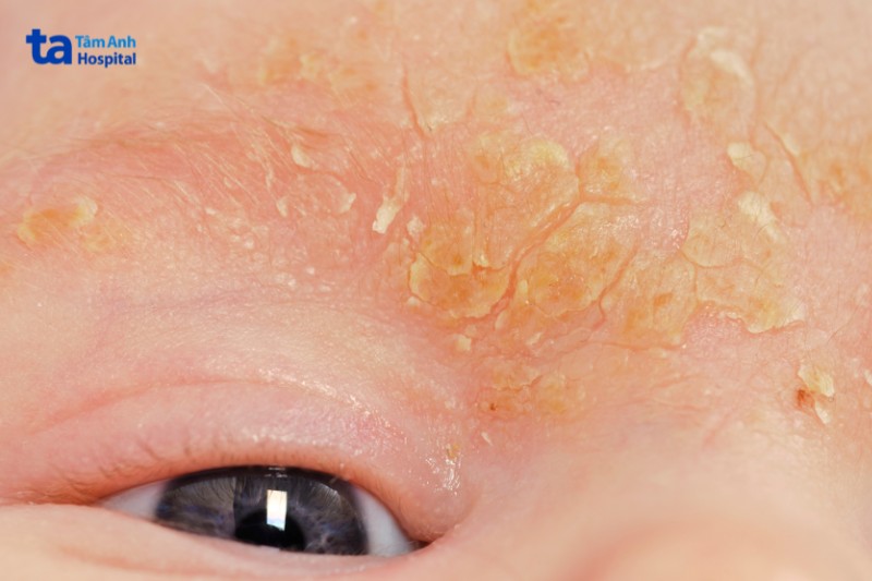 trẻ em bị viêm da tiết bã ở mặt