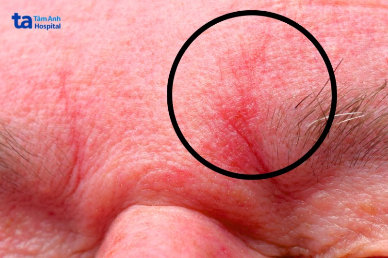 vùng trán trên mặt bị viêm da tiết bã