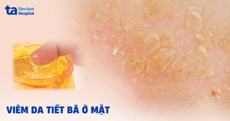 Viêm da tiết bã ở mặt: Hình ảnh, nguyên nhân và cách cải thiện