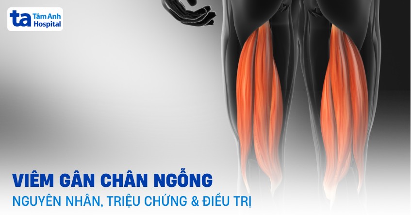viêm gân chân ngỗng